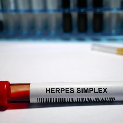 Anogenitalna infekcija uzrokovana virusom herpesa [herpes simplex]