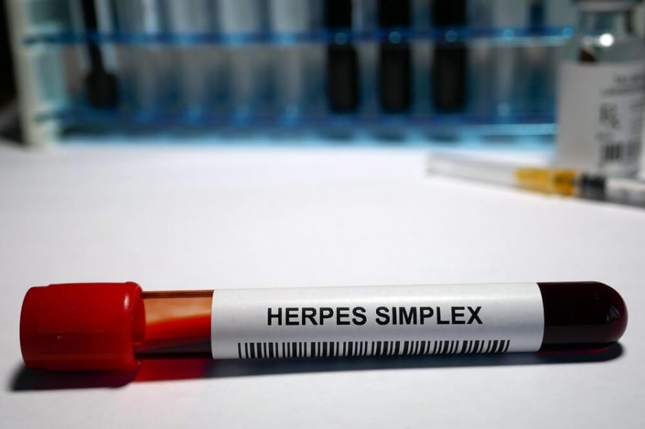 Anogenitalna infekcija uzrokovana virusom herpesa [herpes simplex]