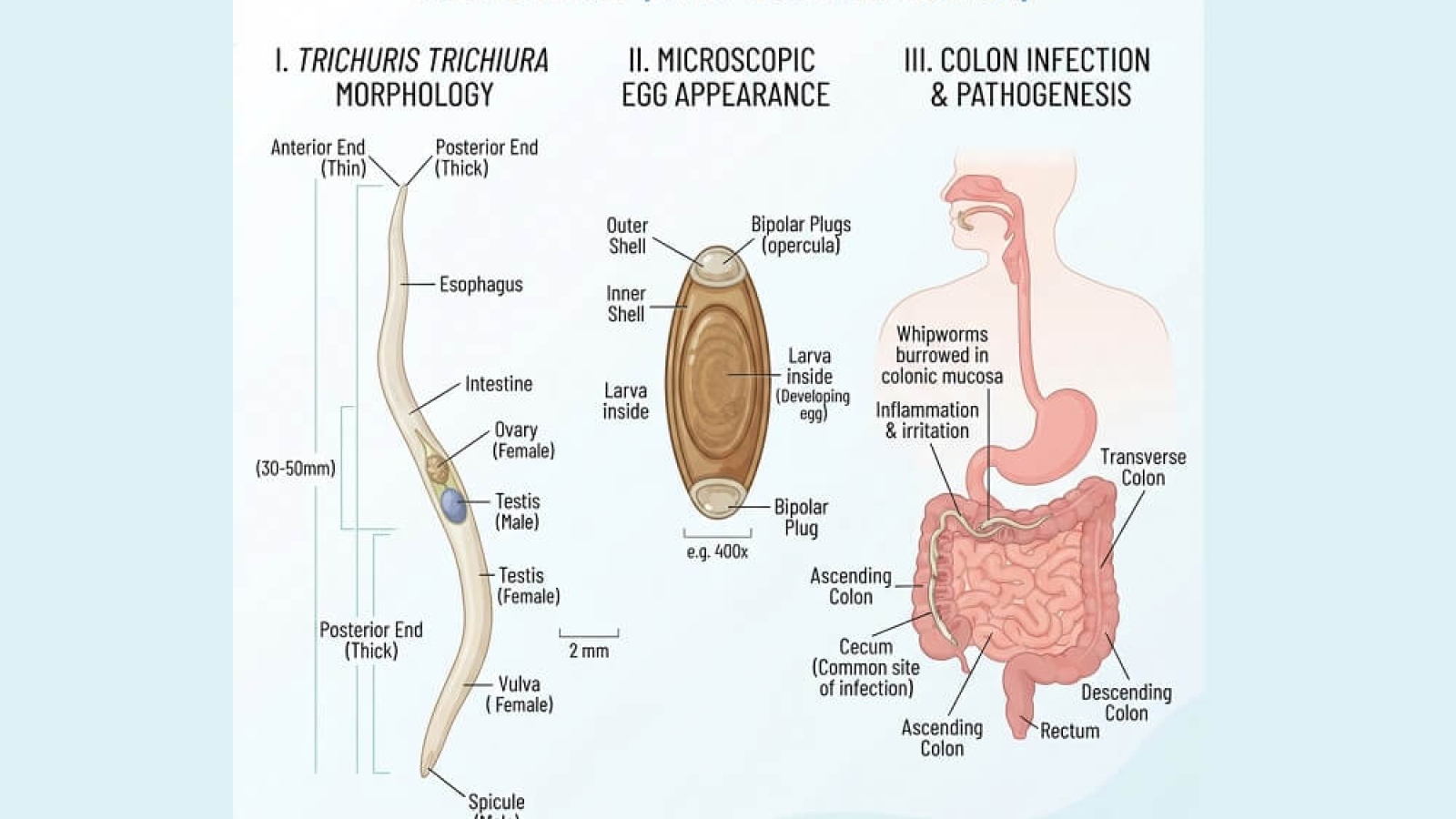 Trichuriasis, ilustracija